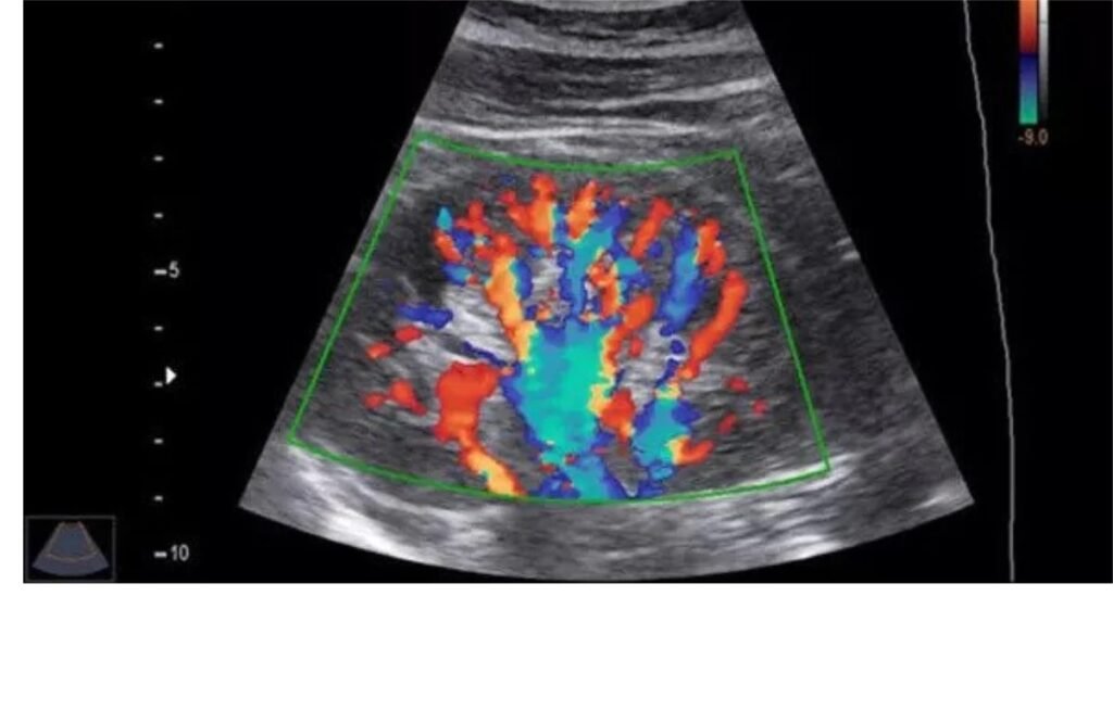 Power of Color Doppler Ultrasound : Nidaan Diagnostic and Pathology Centre